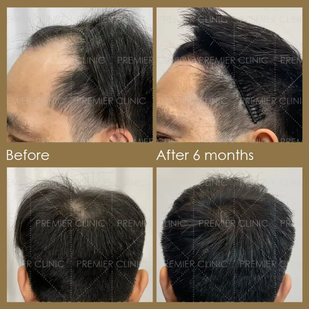 Premier FUE Before & After
