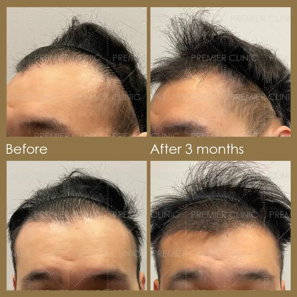 Premier FUE Before & After