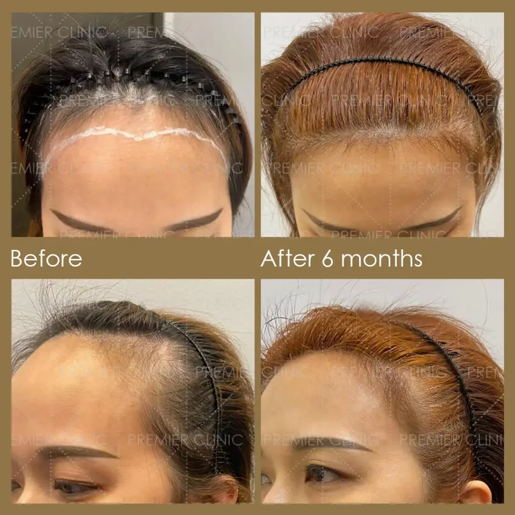 Premier FUE Before & After