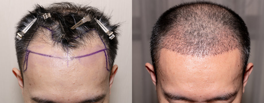 hair transplation before and after