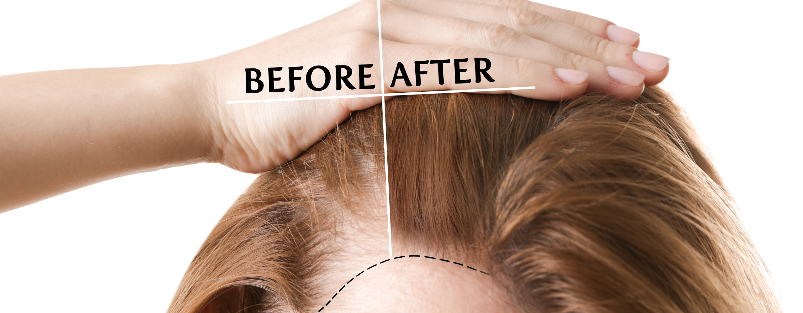 Hair Loss 4 laser treatment for hair growth