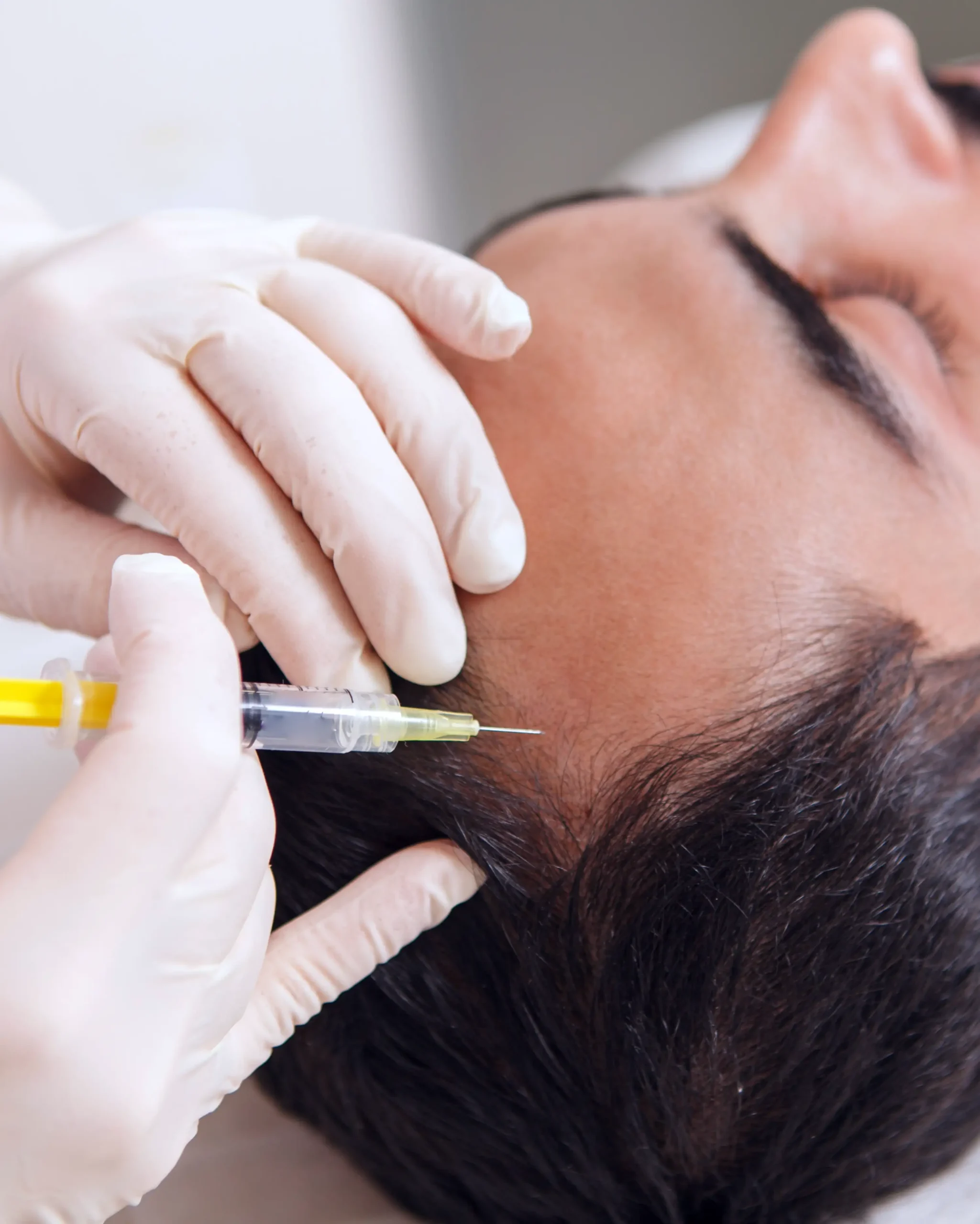 Hair Vitamin (Hair Mesotherapy)