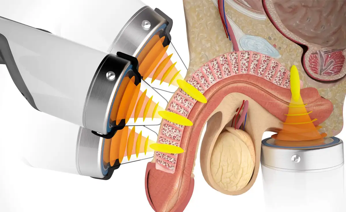 Penile Shockwave Therapy at Premier Clinic