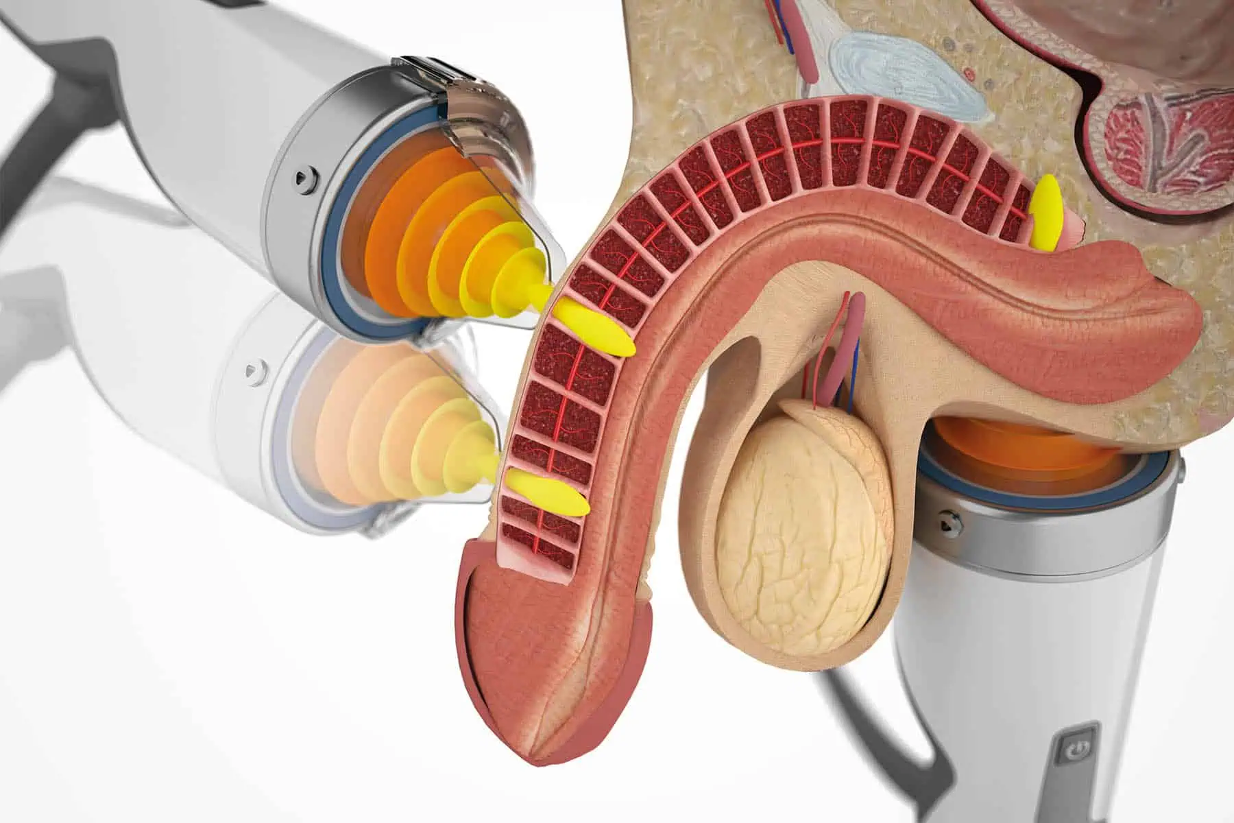 shockwave-therapy-treatment
