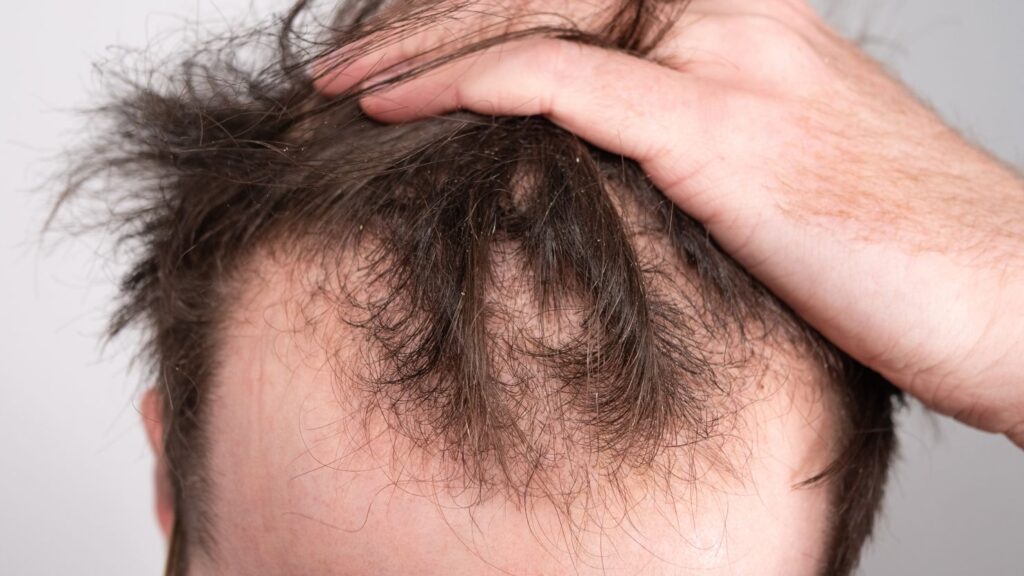 hair loss