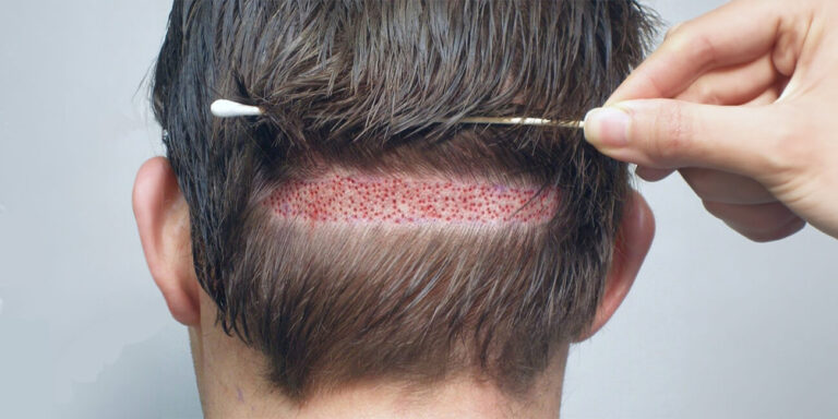 hair loss treatment