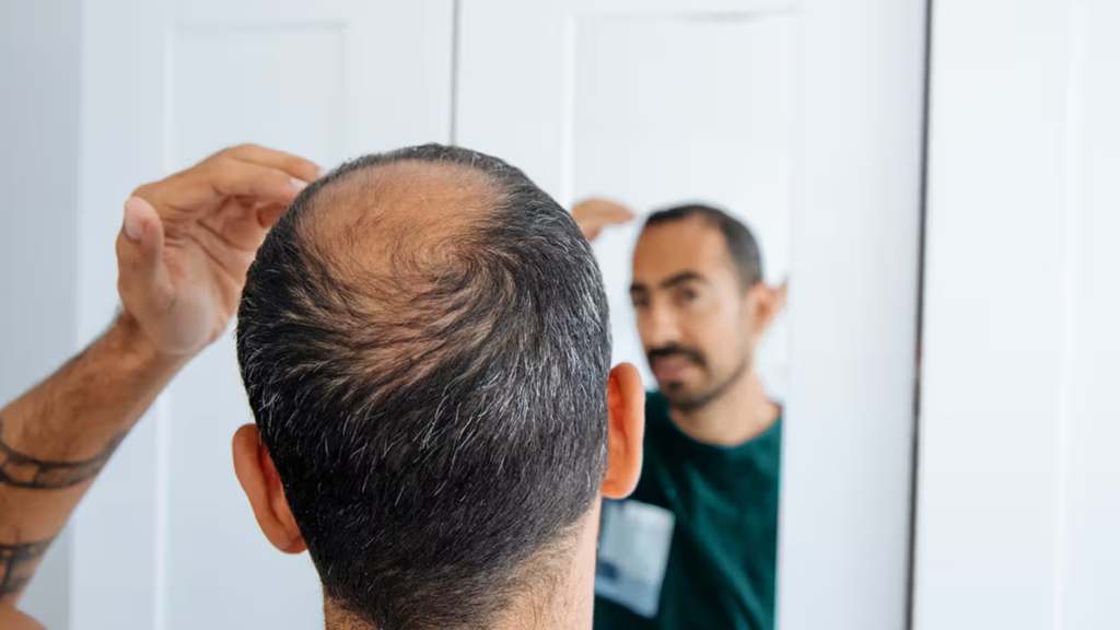 hairloss man looking at the mirror