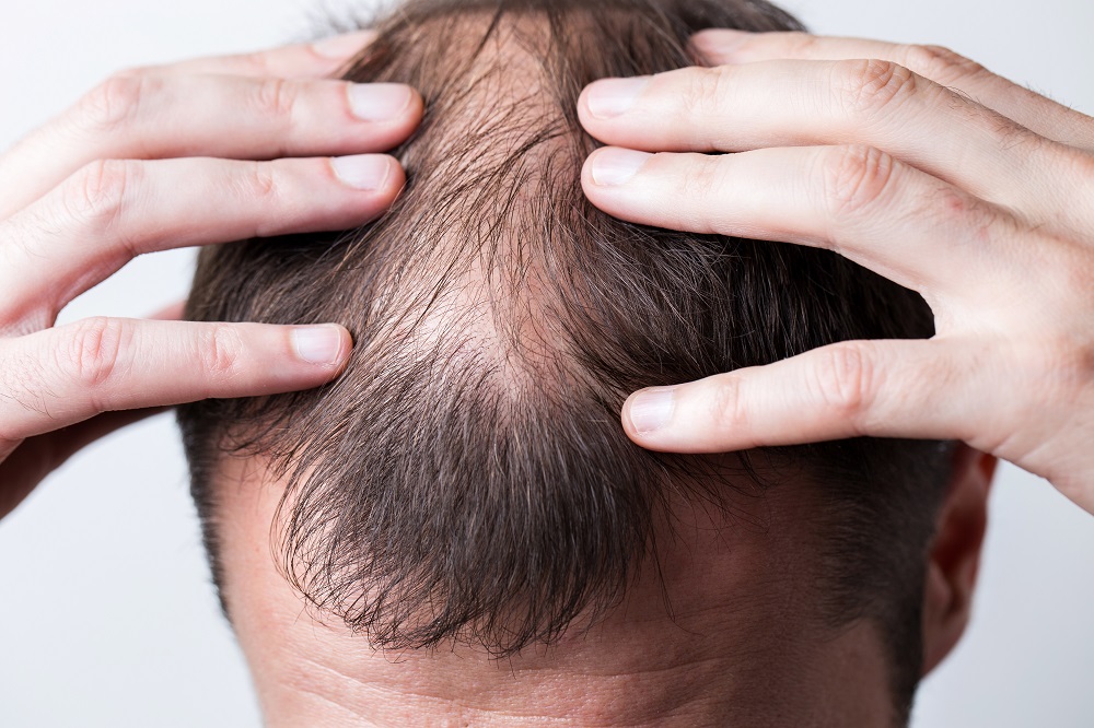men with hair loss issue