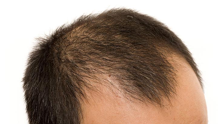 male baldness