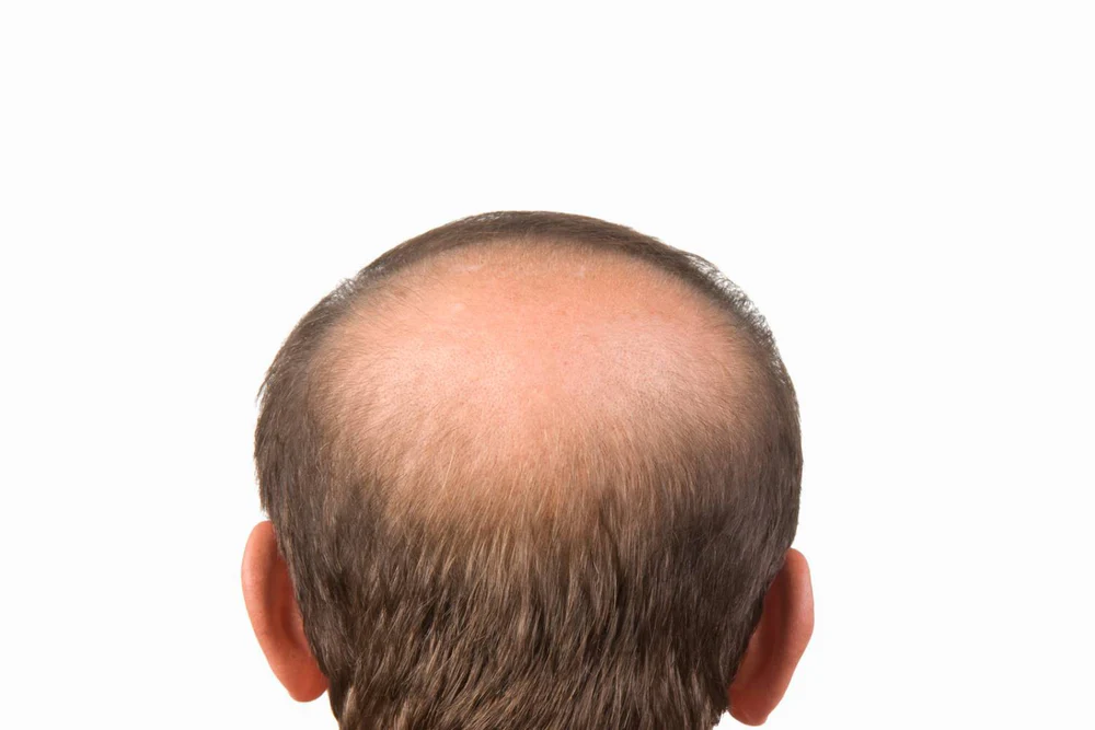 male balding