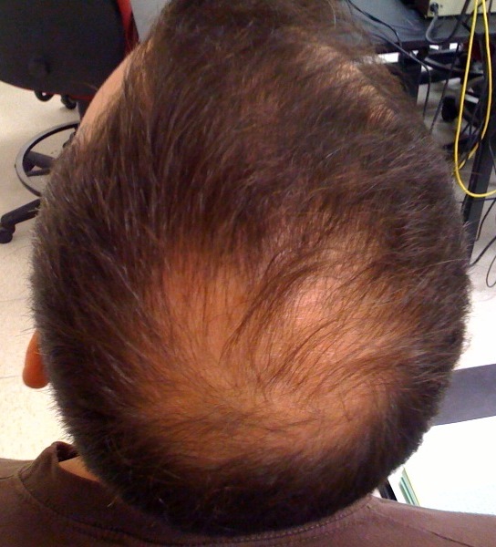 a guy balding