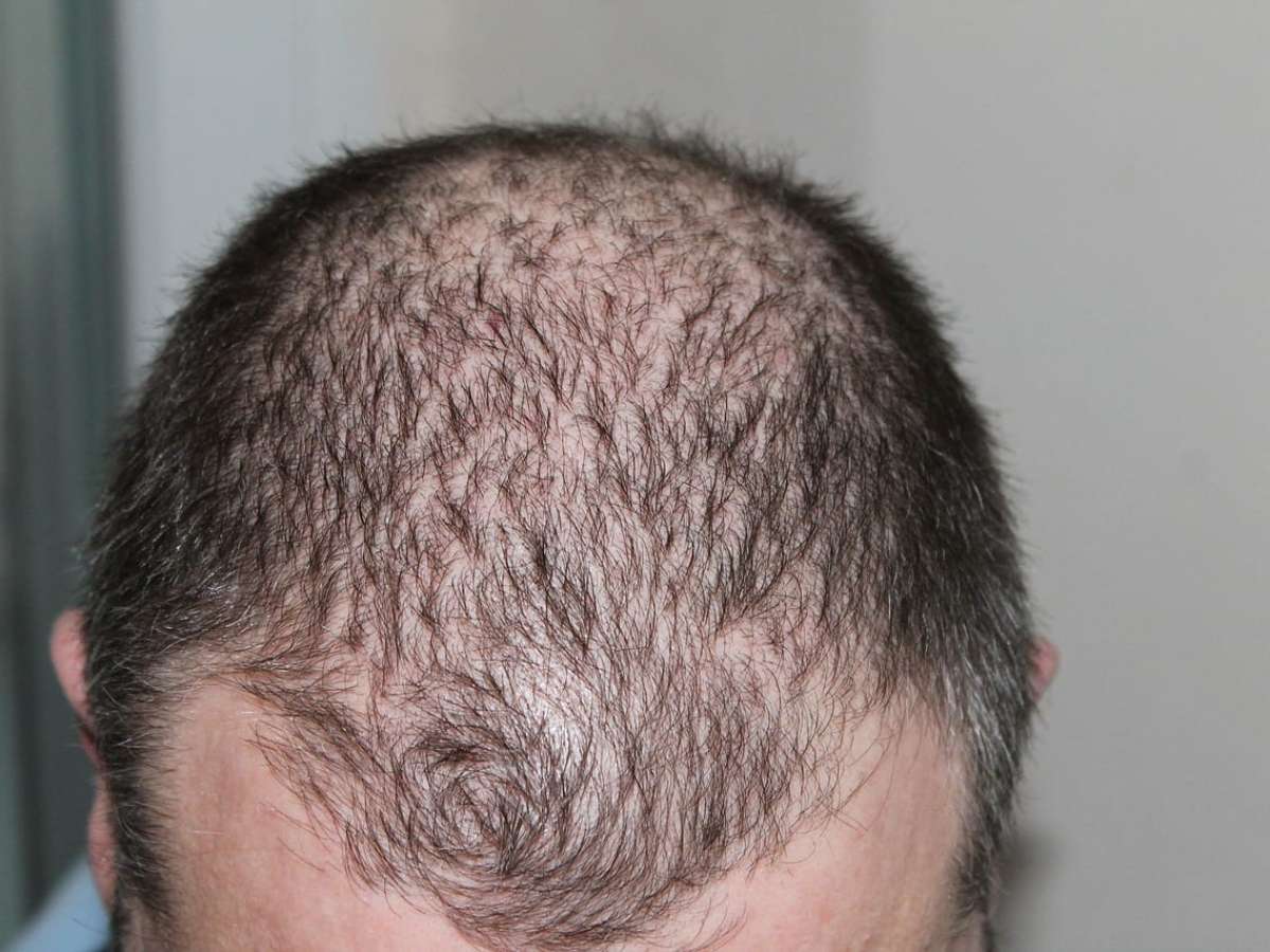 man going bald