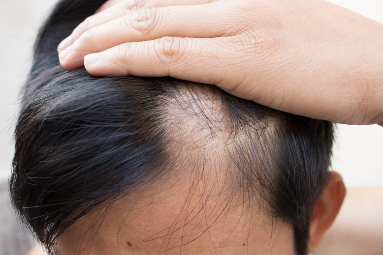 guy going bald