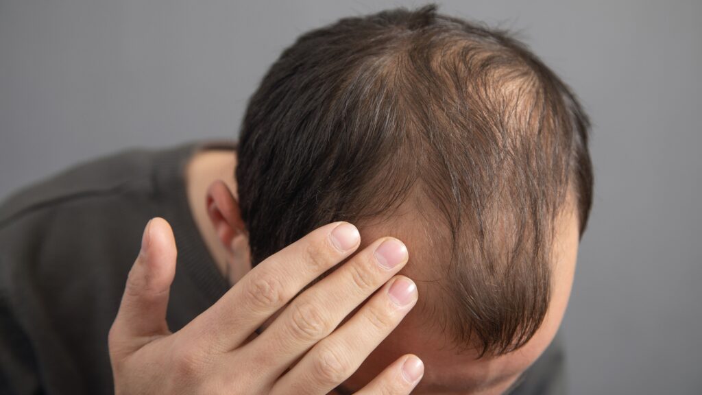 a guy with balding hair
