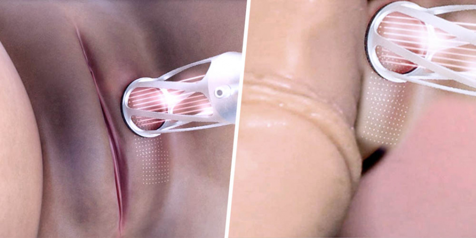 Genital-Whitening-01-1
